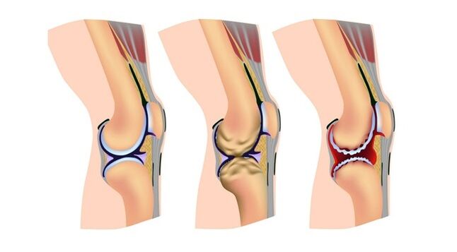 stages of knee arthrosis