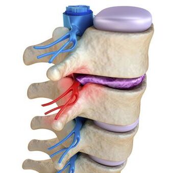 A pinched nerve in the spine is accompanied by a shooting pain