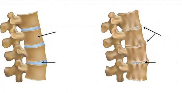 ischemic syndrome to osteochondrosis