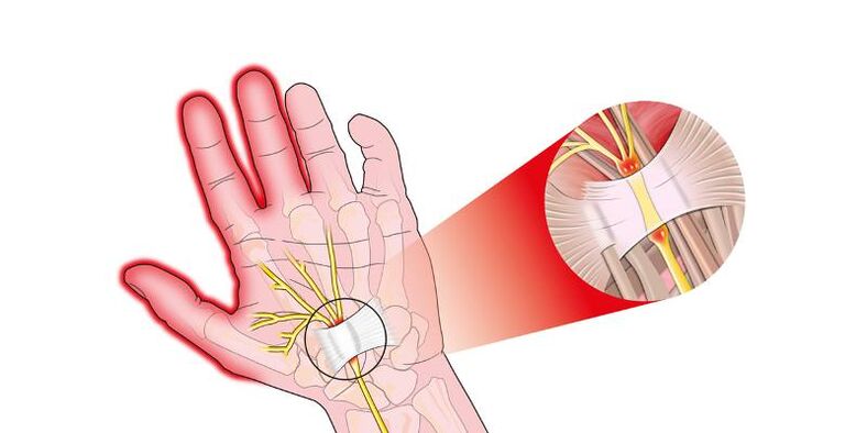 Pain in the joints of risartrosis fingers